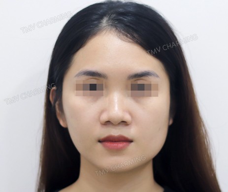 Mũi lót sụn – cắt cánh – cắt xương