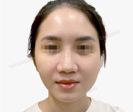 Mũi lót sụn – cắt cánh – cắt xương