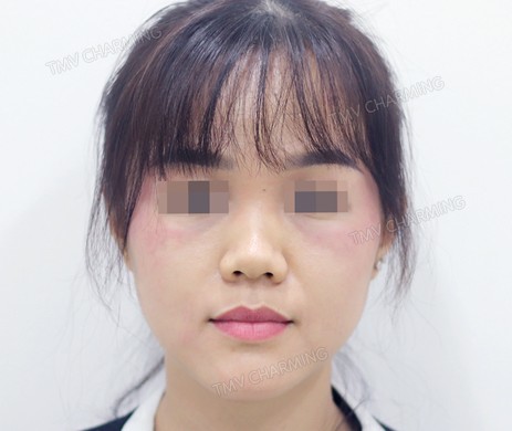 Mũi lót sụn – thu chóp