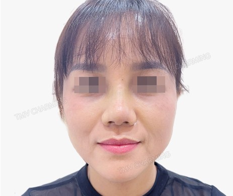 Mũi lót sụn – thu chóp