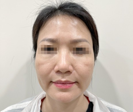 Độn thái dương sau 1,5 năm