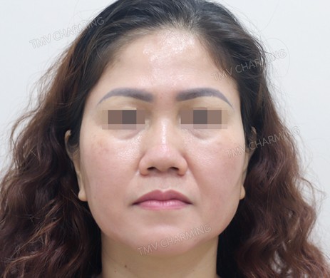 Mũi lót sụn – cắt cánh