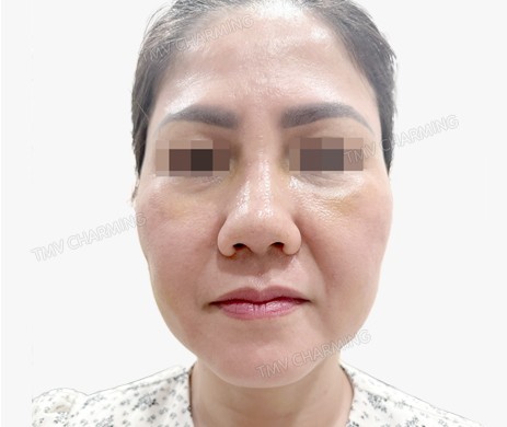 Mũi lót sụn – cắt cánh