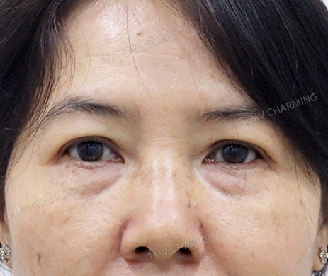 Cắt mí trên – mí dưới