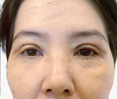 Cắt mí trên – mí dưới