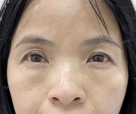 Treo cung mày + cắt mí dưới