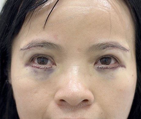 Treo cung mày + cắt mí dưới