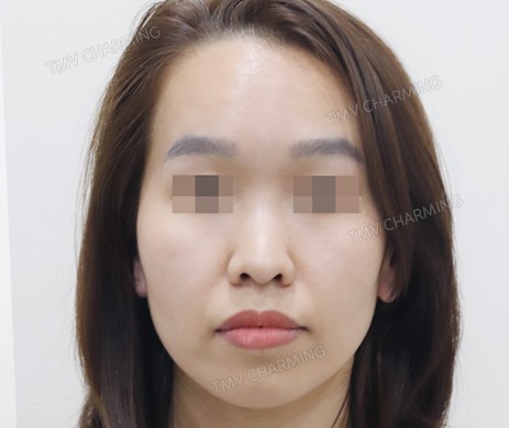 Mũi lót sụn + cắt xương