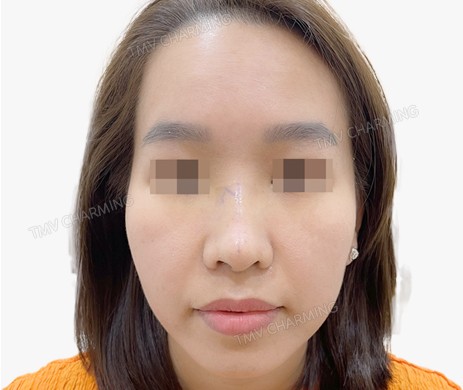 Mũi lót sụn + cắt xương