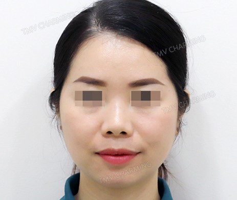 Mũi lót sụn + Độn cằm