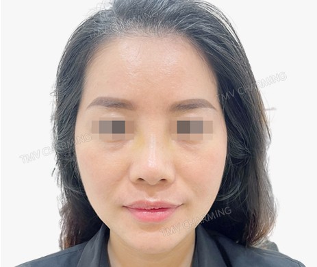 Mũi lót sụn + Độn cằm