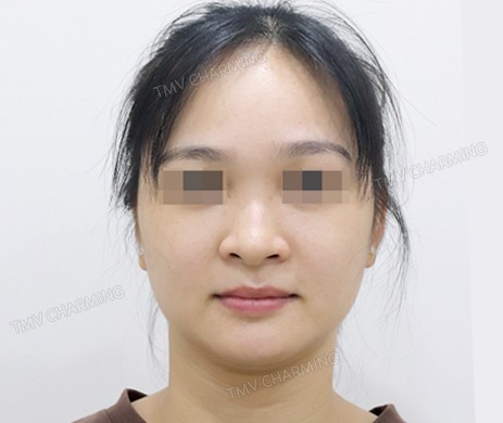 mũi nhân tạo + cắt xương