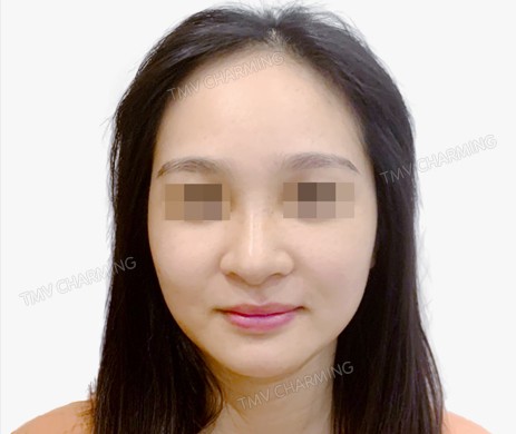 mũi nhân tạo + cắt xương