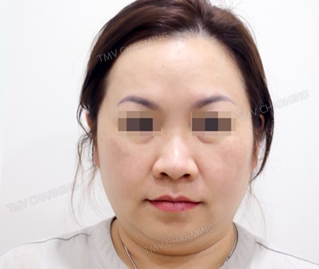 mũi lót sụn + cắt cánh mũi