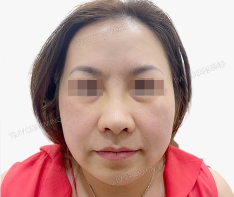 mũi lót sụn + cắt cánh mũi