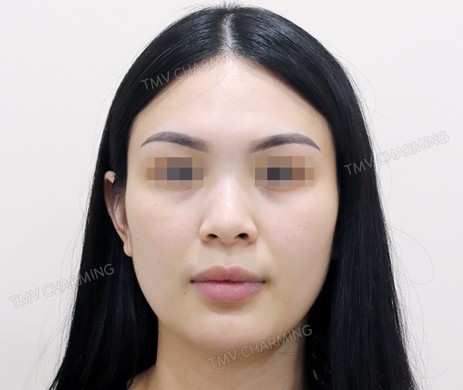 Mũi lót sụn + cắt cánh + thu chóp