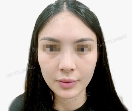 Mũi lót sụn + cắt cánh + thu chóp