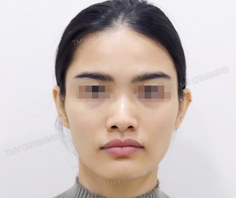 Mũi lót sụn + cắt cánh + thu chóp + cắt xương (T)