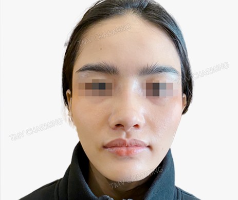 Mũi lót sụn + cắt cánh + thu chóp + cắt xương (T)