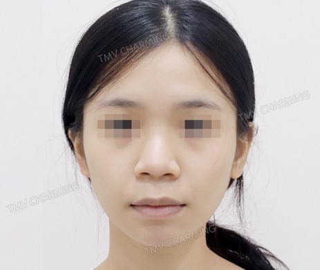 Mũi lót sụn + Độn cằm