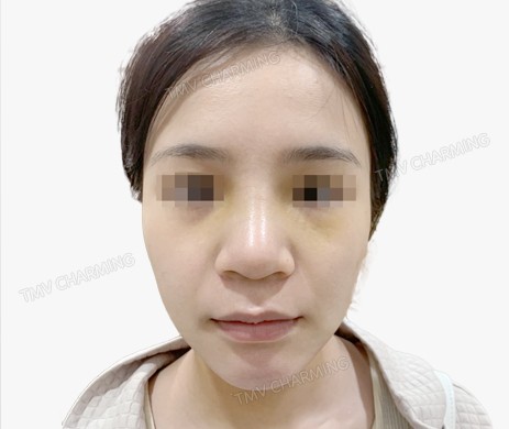 Mũi lót sụn + Độn cằm