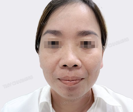 Mũi lót sụn + cắt cánh + Độn cằm