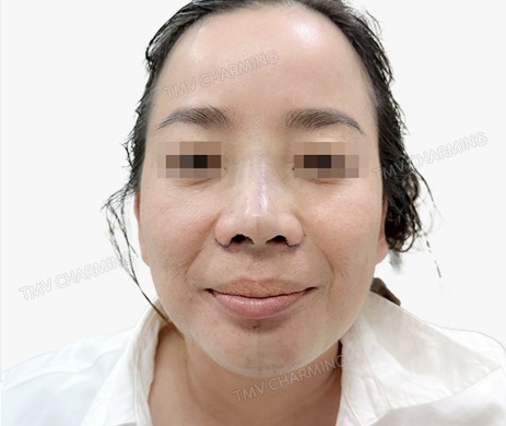 Mũi lót sụn + cắt cánh + Độn cằm