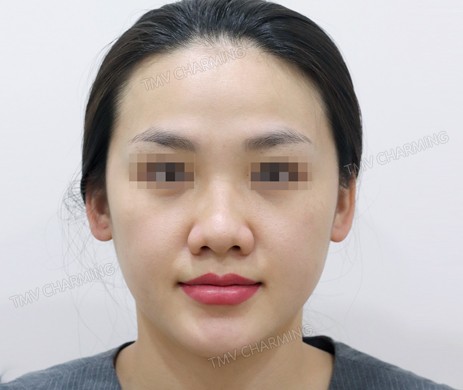 Mũi lót sụn + cà gồ