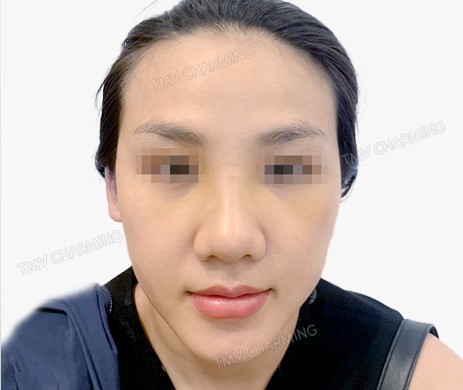 Mũi lót sụn + cà gồ