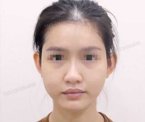 Mũi lót sụn + cắt xương + lấy chỉ