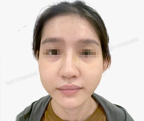 Mũi lót sụn + cắt xương + lấy chỉ