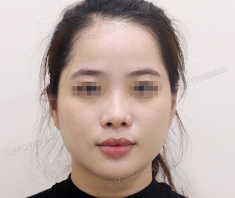 Mũi lót sụn + thu chóp + cắt xương