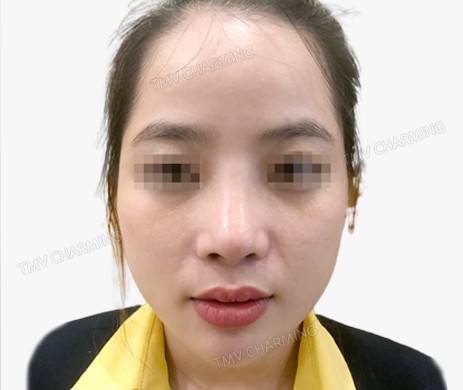 Mũi lót sụn + thu chóp + cắt xương