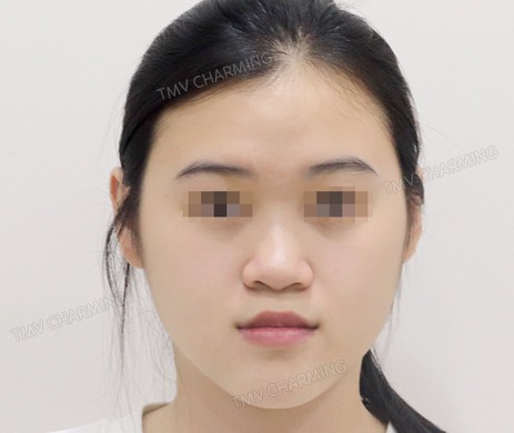 Mũi lót sụn + cắt xương + lấy chỉ