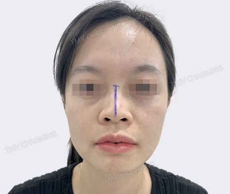 Mũi lót sụn + cắt xương + độn cằm