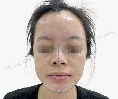 Mũi lót sụn + cắt xương + độn cằm