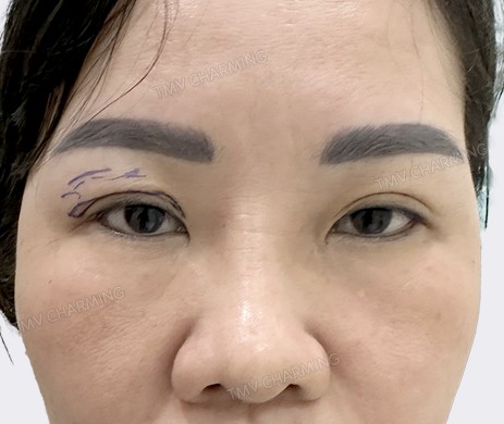 cắt mí trên mắt phải