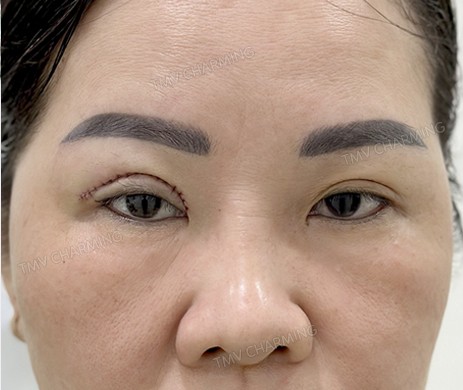 cắt mí trên mắt phải