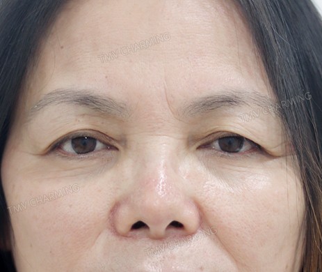 cắt mí trên sau 1 tháng