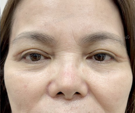 cắt mí trên sau 1 tháng