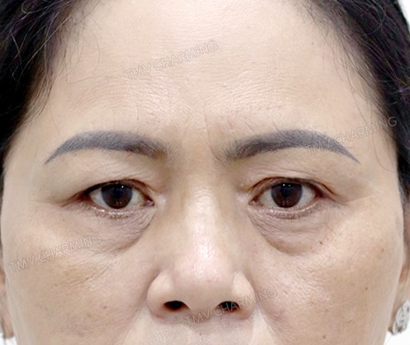 Cắt mí trên mí dưới + cấy mỡ mí dưới