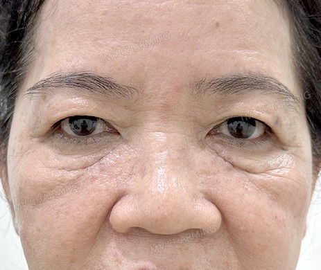 cắt mí trên + mí dưới