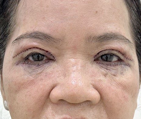 cắt mí trên + mí dưới