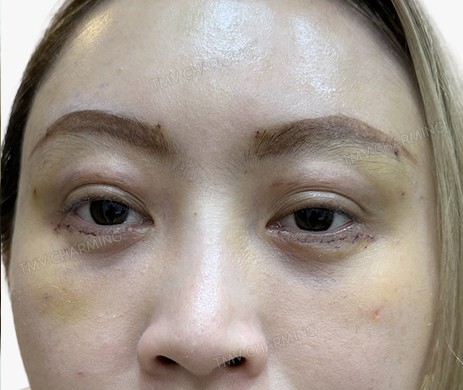 Cắt mí dưới + cấy mỡ mí trên + mí dưới