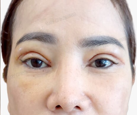 Cắt mí trên + Cấy mỡ mí (P)