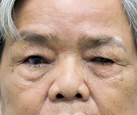 Treo cung mày + Cắt mí trên