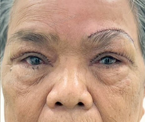 Treo cung mày + Cắt mí trên