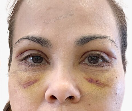 Cắt + Cấy mỡ mí trên mí dưới