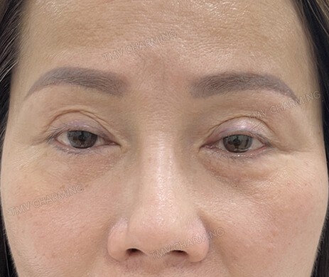 Cấy mỡ mí trên mí dưới