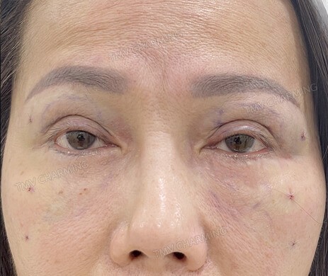 Cấy mỡ mí trên mí dưới